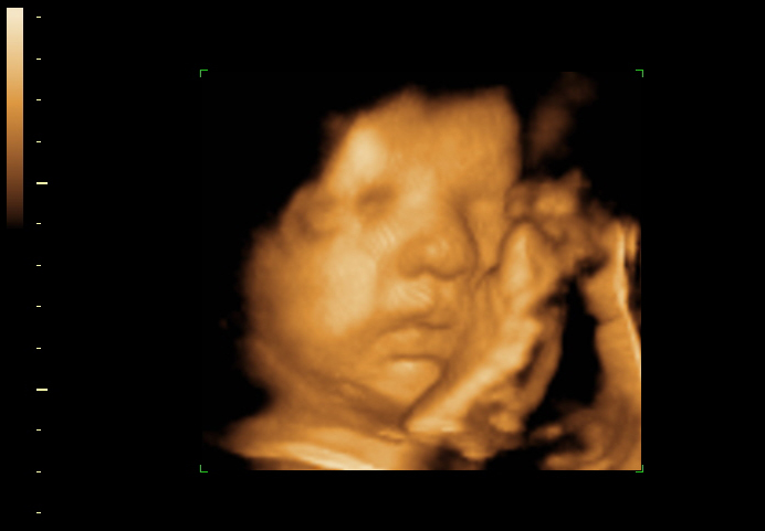 3D ultrasound image at 32 weeks